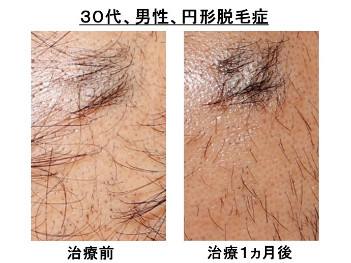 円形脱毛症　病院